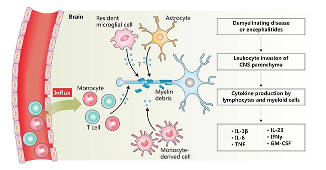 神經炎癥的示意圖